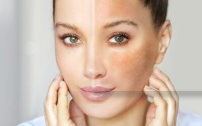 Skin Health with Omega-3